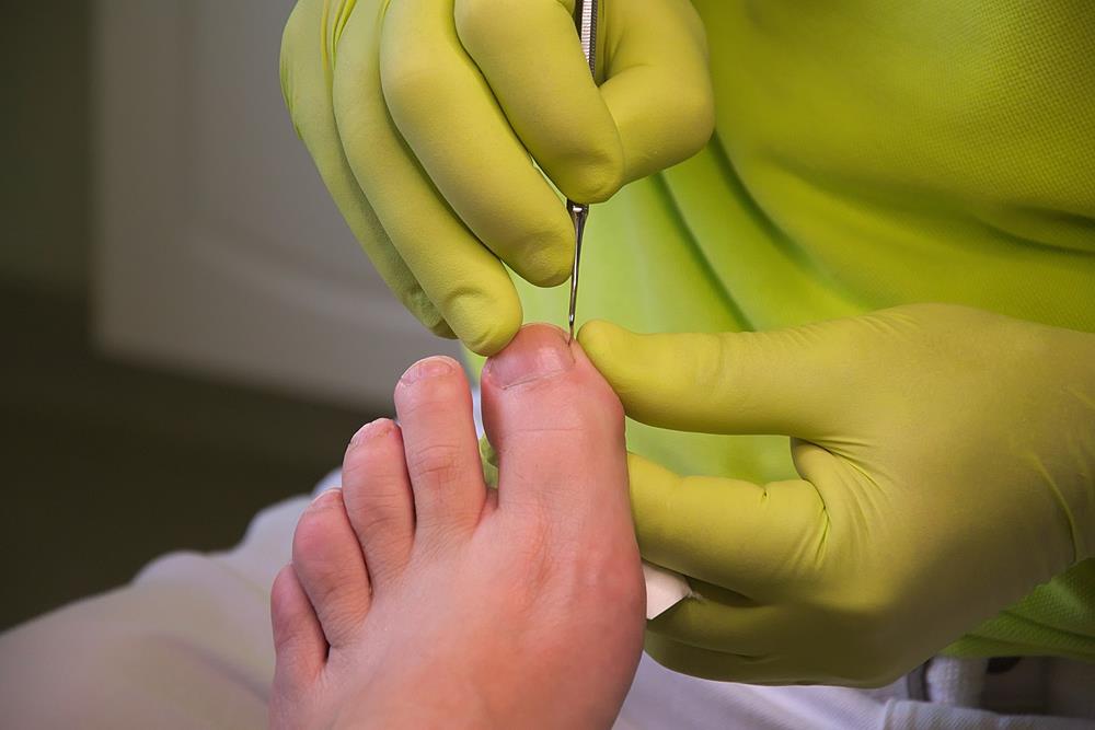 Ingrown Toenails  Peoria, IL 